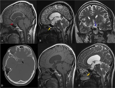Ventriculoperitoneal Shunt Alone for Cerebrospinal Fluid Rhinorrhea With Neuroendocrine Alterations in Idiopathic Intracranial Hypertension: A Case Report and Literature Review